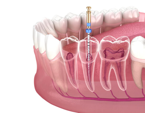 root canal